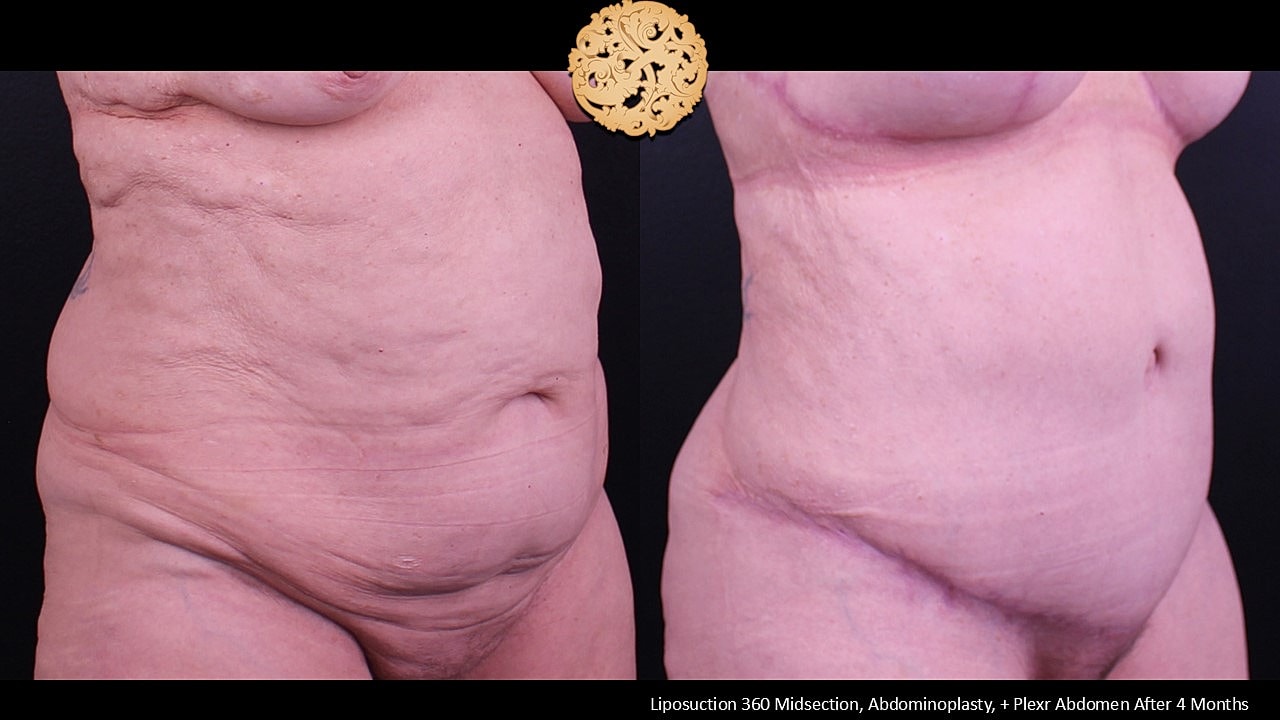 Plexr Before & After