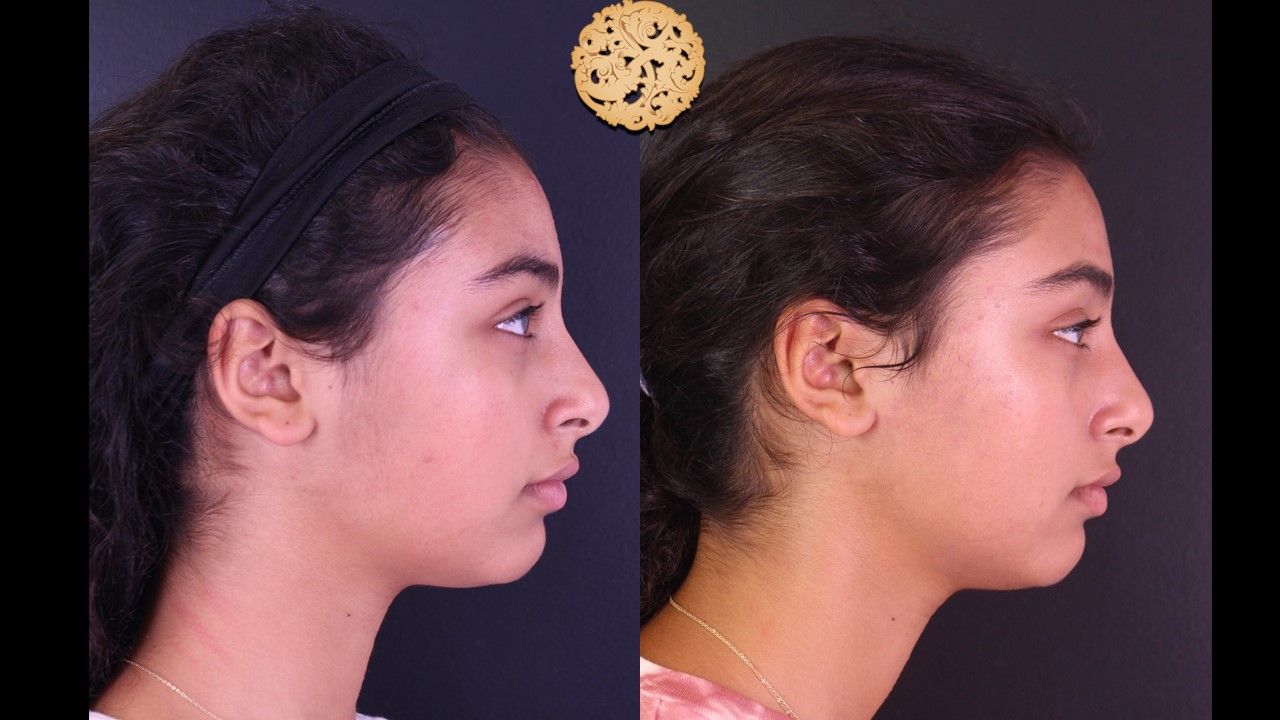 LED LightStim Before & After