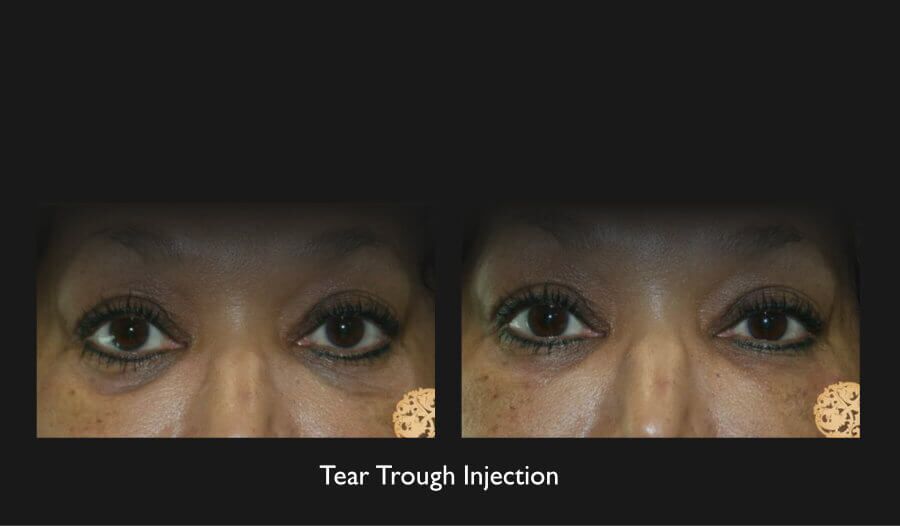 Tear Troughs Before & After
