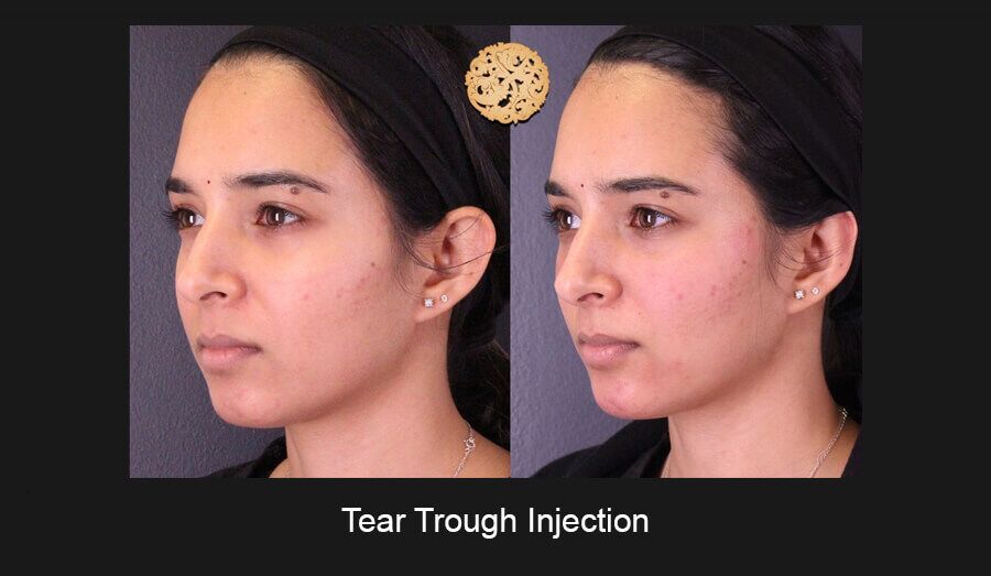 Tear Troughs Before & After