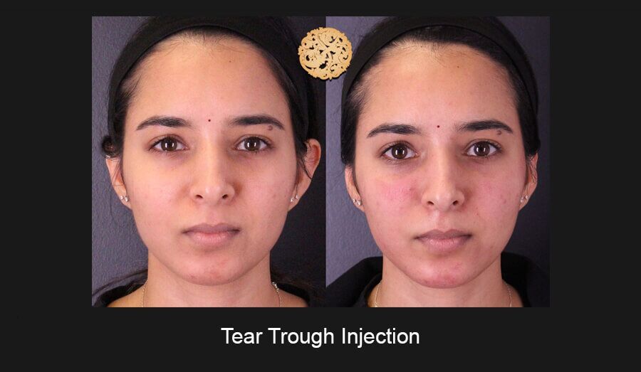 Tear Troughs Before & After