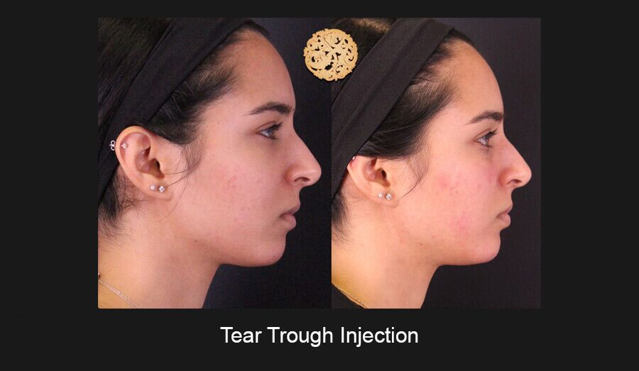 Tear Troughs Before & After