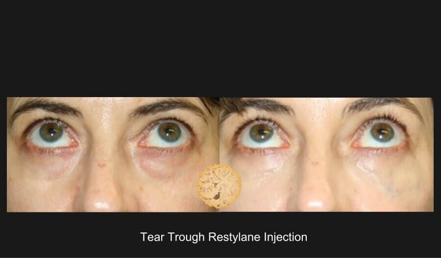 Tear Troughs Before & After