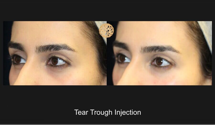Tear Troughs Before & After