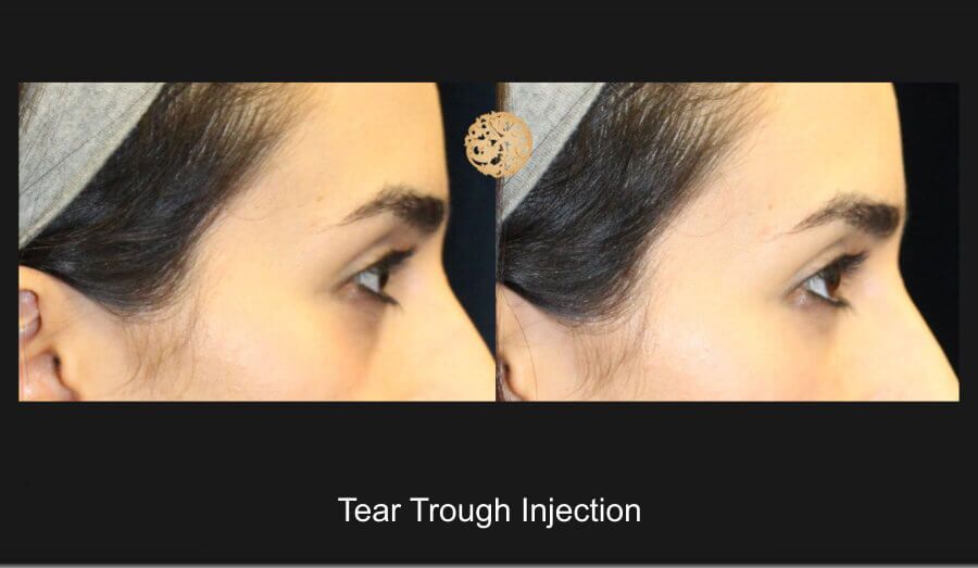 Tear Troughs Before & After