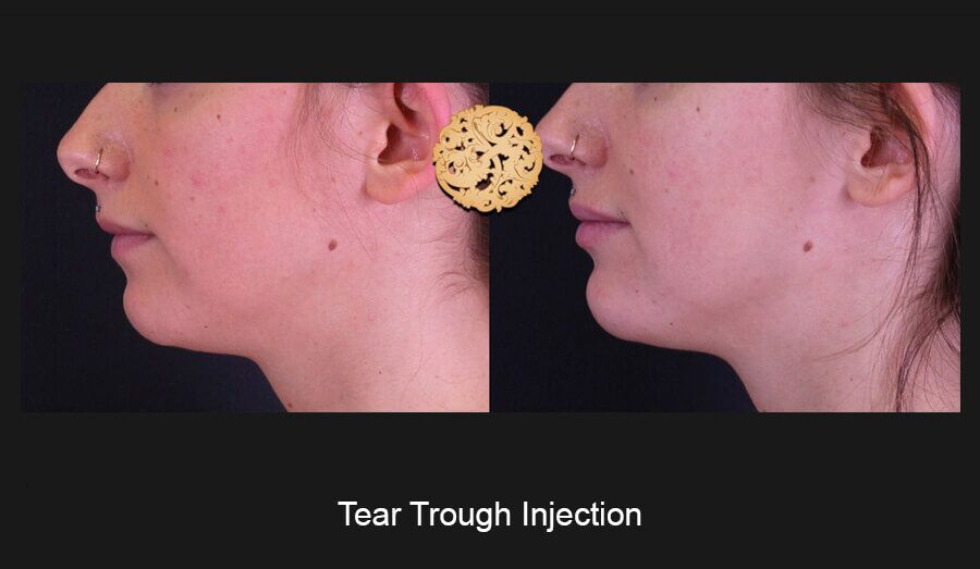 Tear Troughs Before & After
