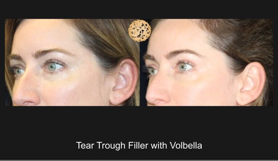 Tear Troughs Before & After