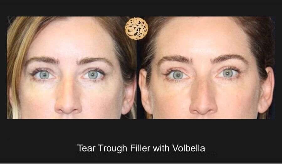 Tear Troughs Before & After