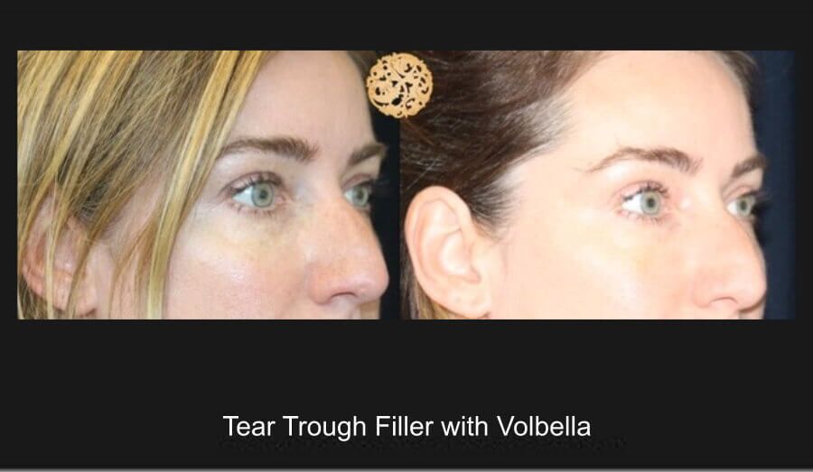 Tear Troughs Before & After