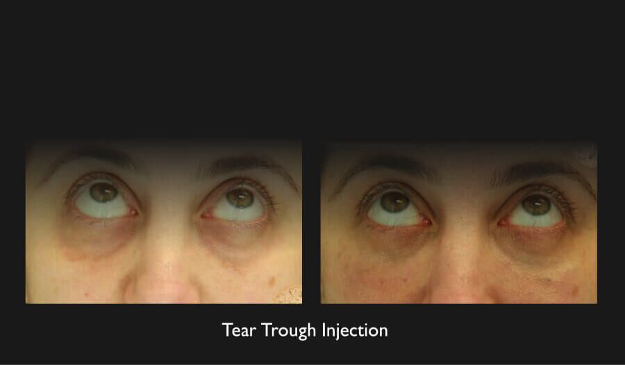 Tear Troughs Before & After