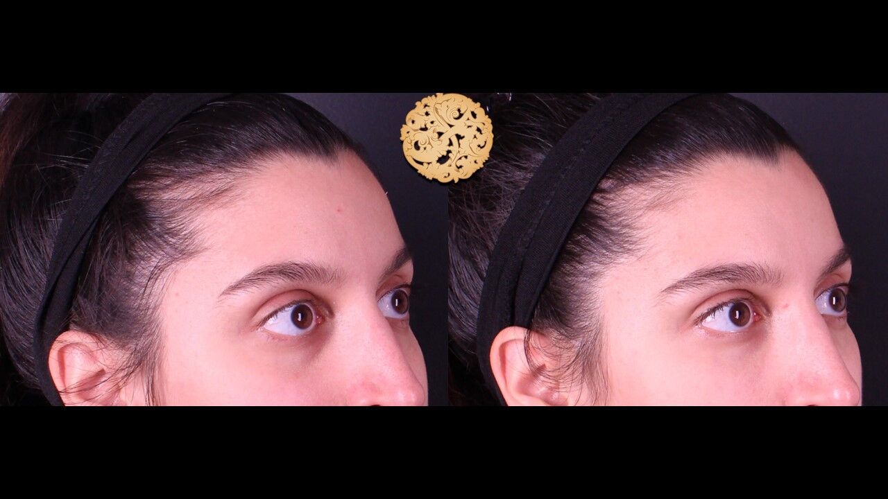 Tear Troughs Before & After