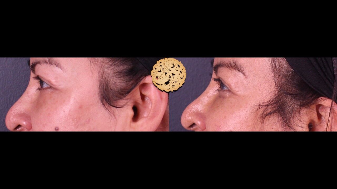 Tear Troughs Before & After