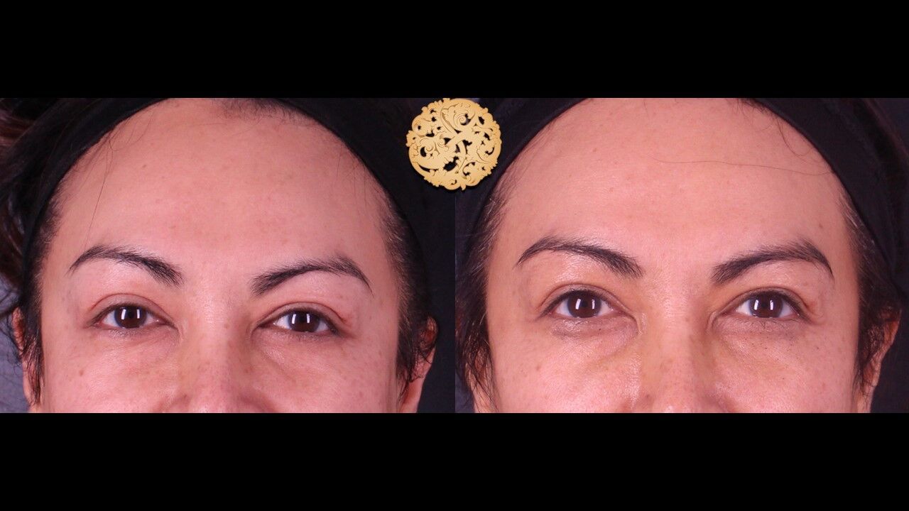 Tear Troughs Before & After