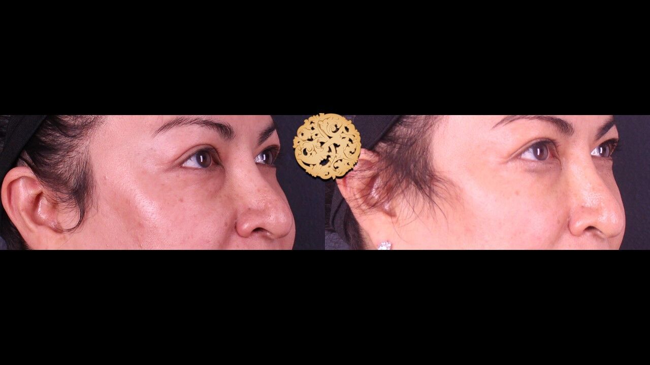 Tear Troughs Before & After