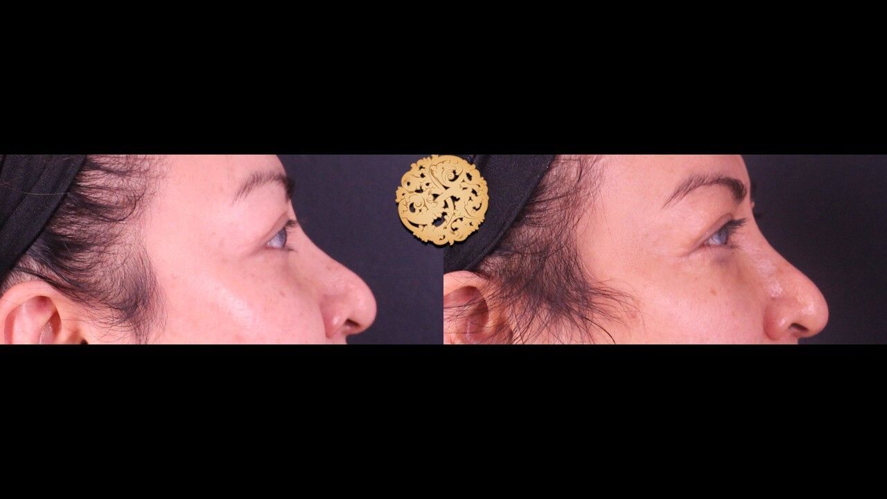 Tear Troughs Before & After