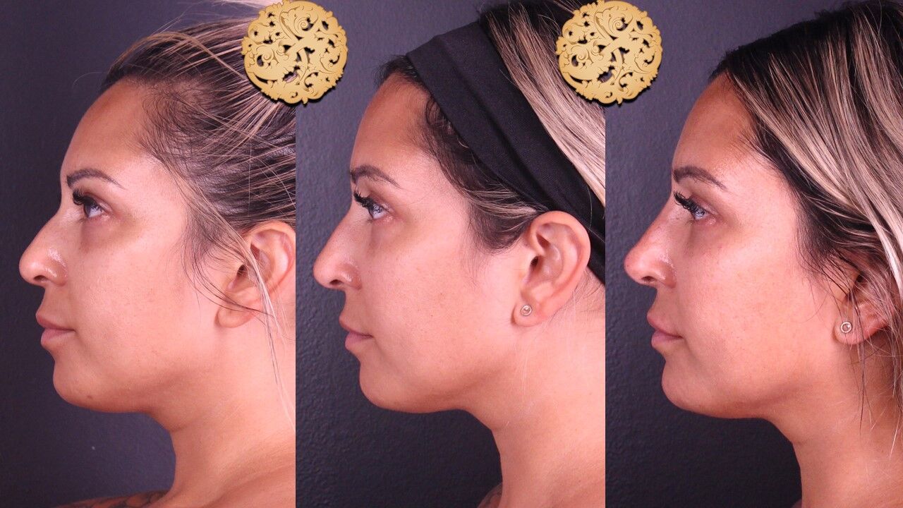 Tear Troughs Before & After