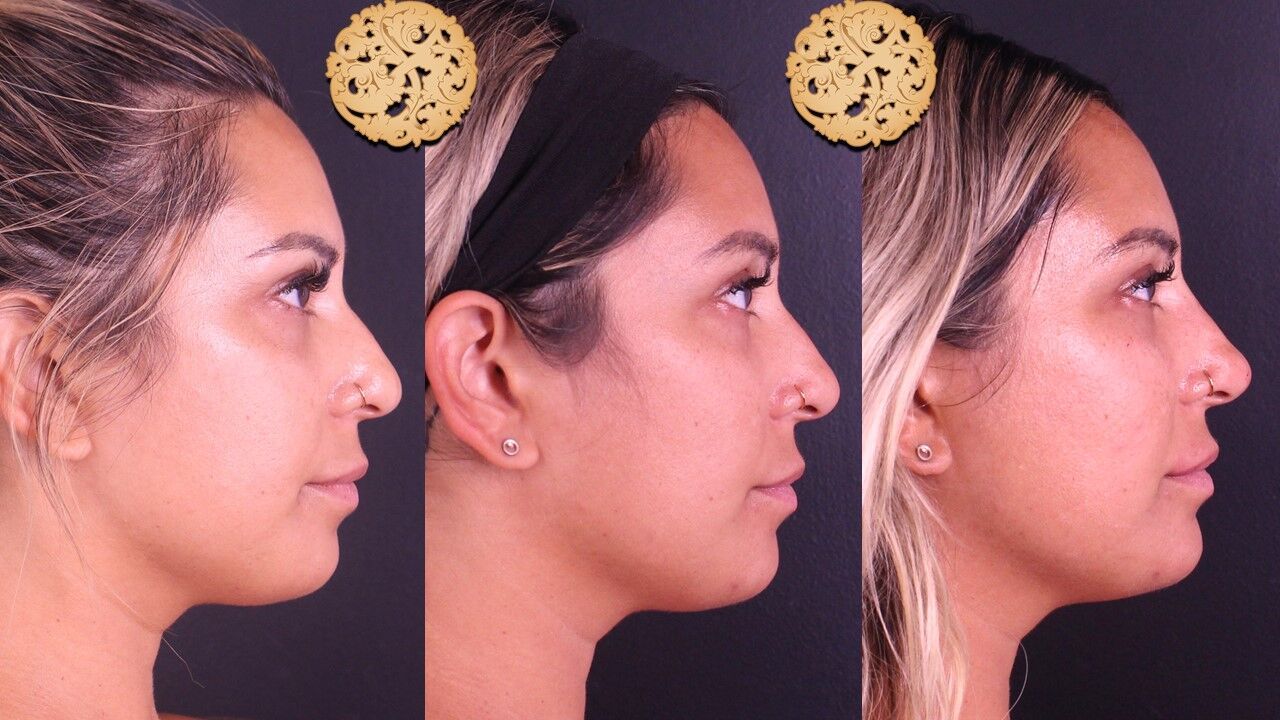 Tear Troughs Before & After