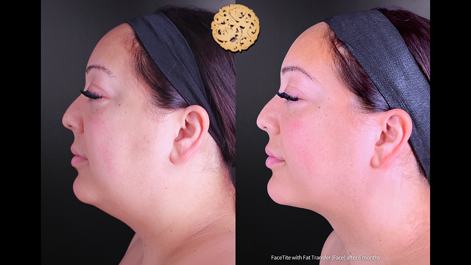 Before & After