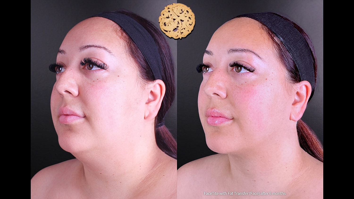 Before & After