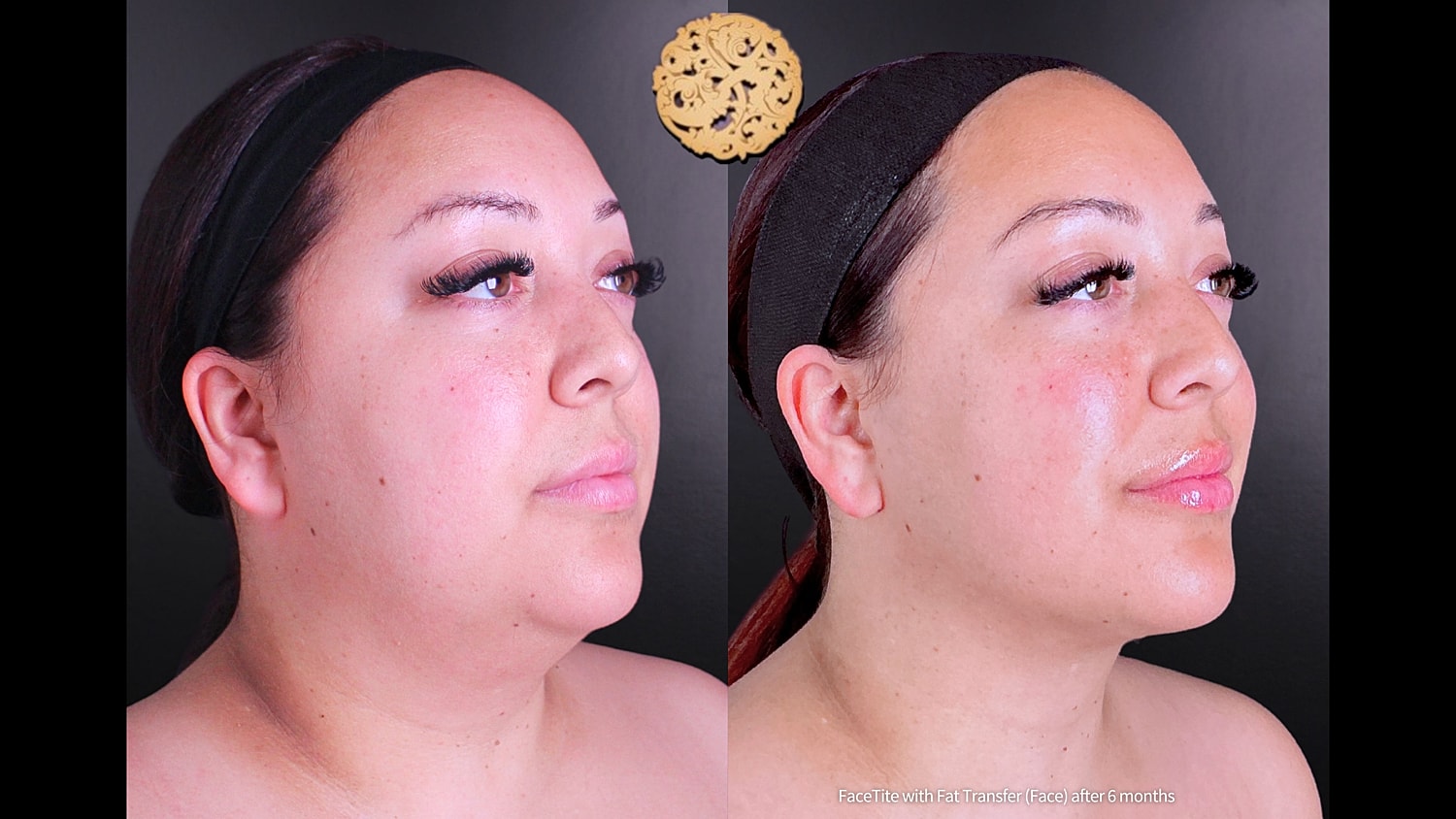 Before & After