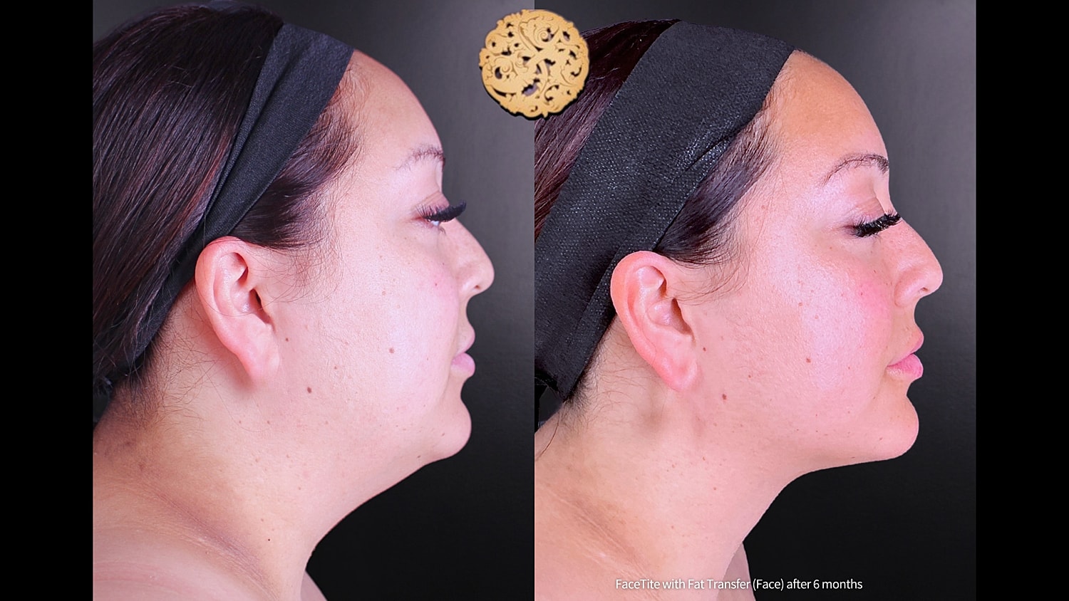 Before & After