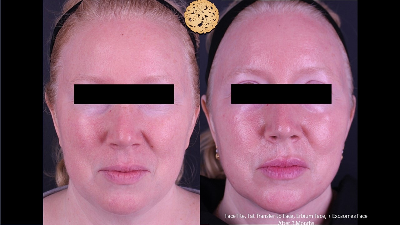 Before and after facial treatment comparison.