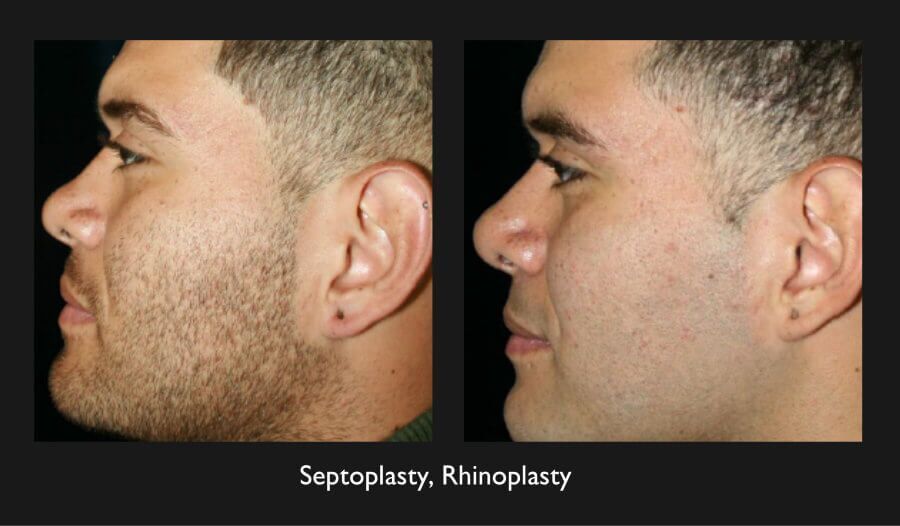 Plastic Surgery For Men Rhinoplasty Nazarian Plastic Surgery