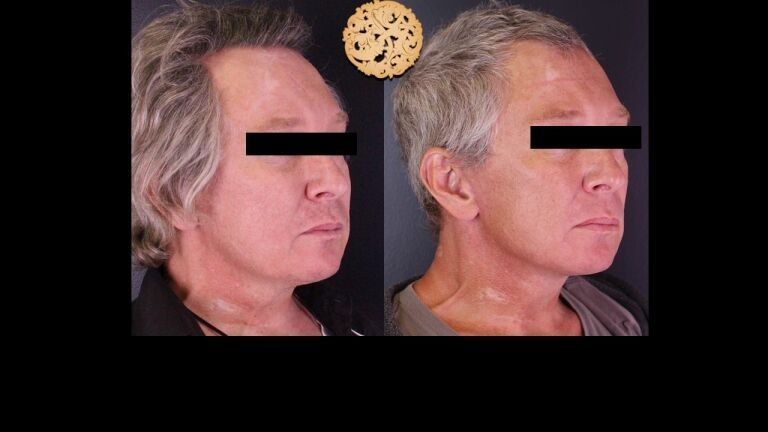 Plastic Surgery For Men Face Lift 768X432 1 Nazarian Plastic Surgery