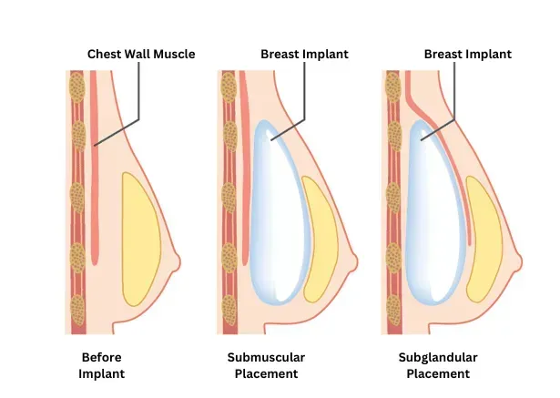 Beverly Hills Breast Implant Placement Comparison: Natural Chest Wall, Beneath Muscle (Submuscular), And Above Muscle (Subglandular) By Dr. Sheila Nazarian.