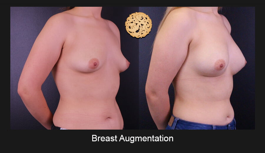 Breast Implants (Augmentation) Gallery