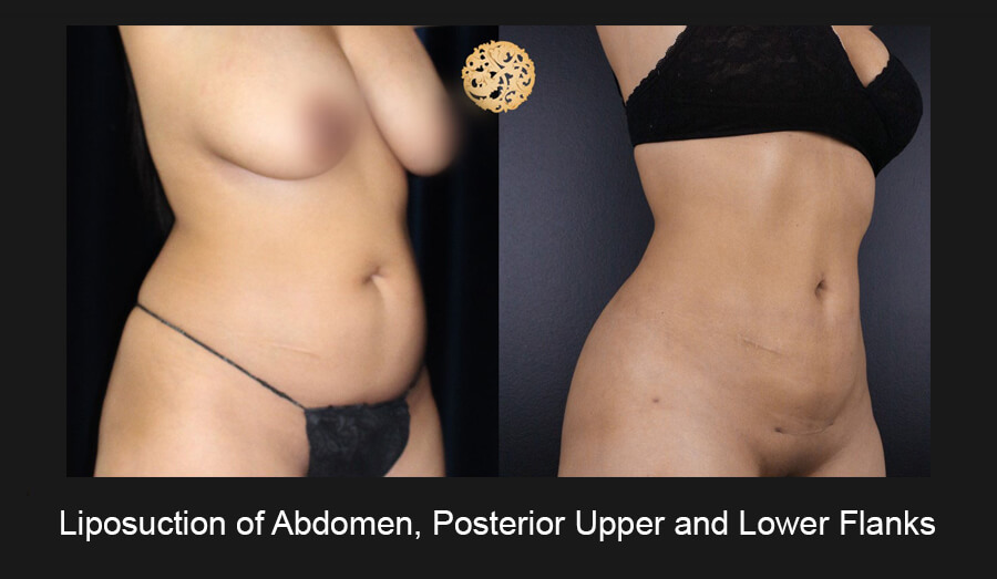 Liposuction Before and After Photo Gallery