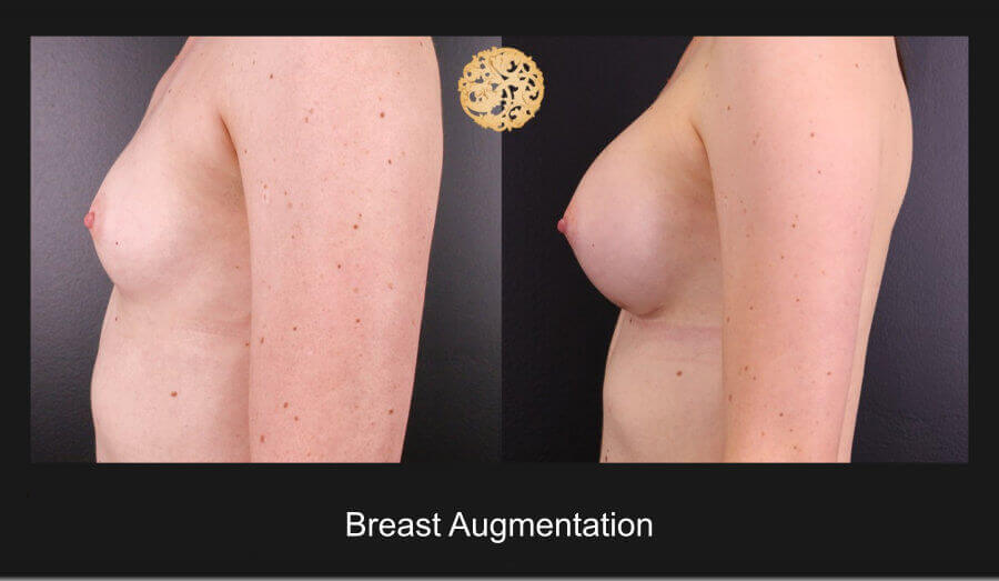 Breast Implants (Augmentation) Gallery