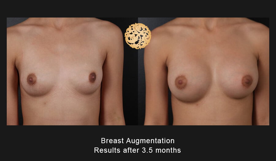 Breast Augmentation Nazarian Plastic Surgery