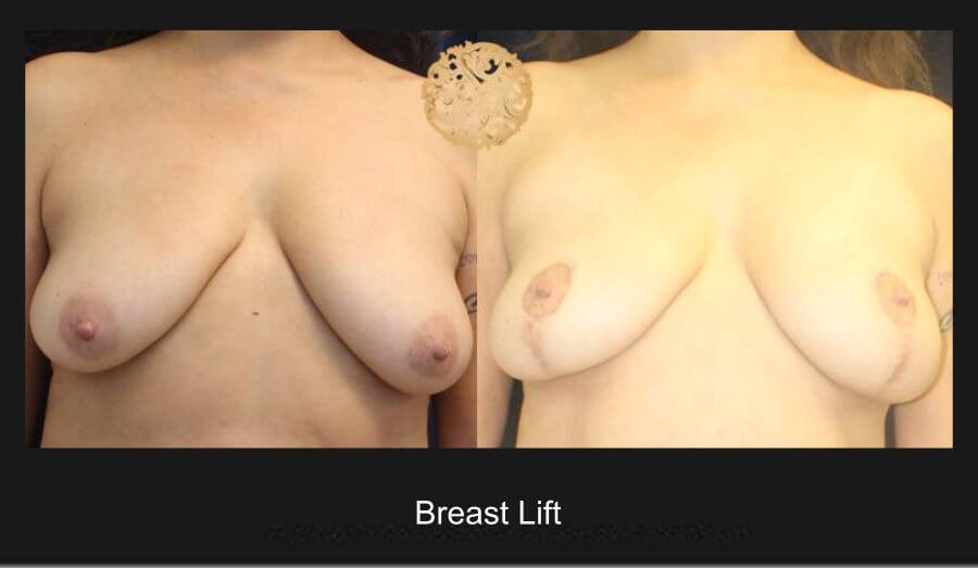 breast-lift-1