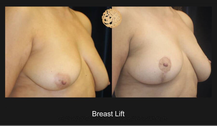 breast-lift-2