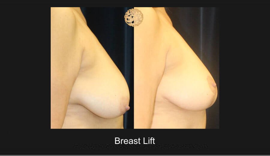 breast-lift-3