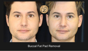 Buccal Fat Pad Nazarian Plastic Surgery