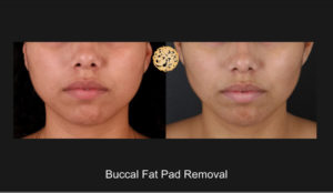 Buccal Fat Pad Reduction Nazarian Plastic Surgery