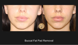 Buccal Fat Pad Removal 1 Nazarian Plastic Surgery