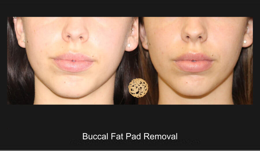 Buccal-Fat Pad Removal
