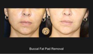 Buccal Fat Removal1A Nazarian Plastic Surgery