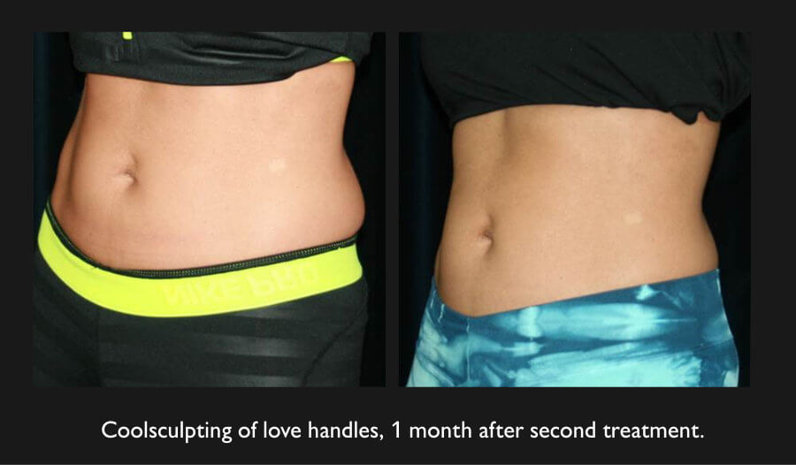 Coolsculpting Before And After Nazarian Plastic Surgery
