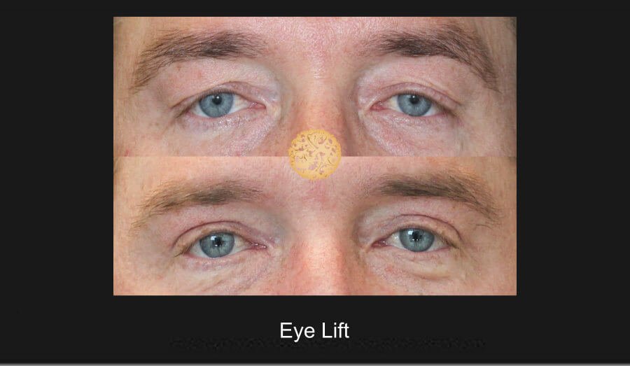 Eye Lift 1A Nazarian Plastic Surgery