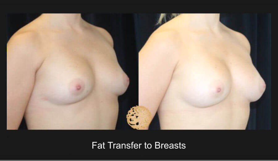Fat Transfer to Breasts Gallery