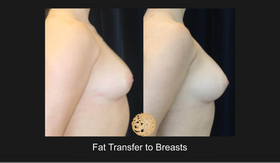 Fat Transfer to Breasts Gallery
