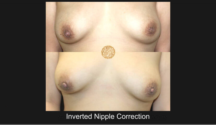 invert-nipple3