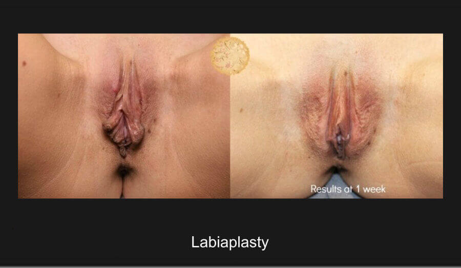 labiaplasty-b