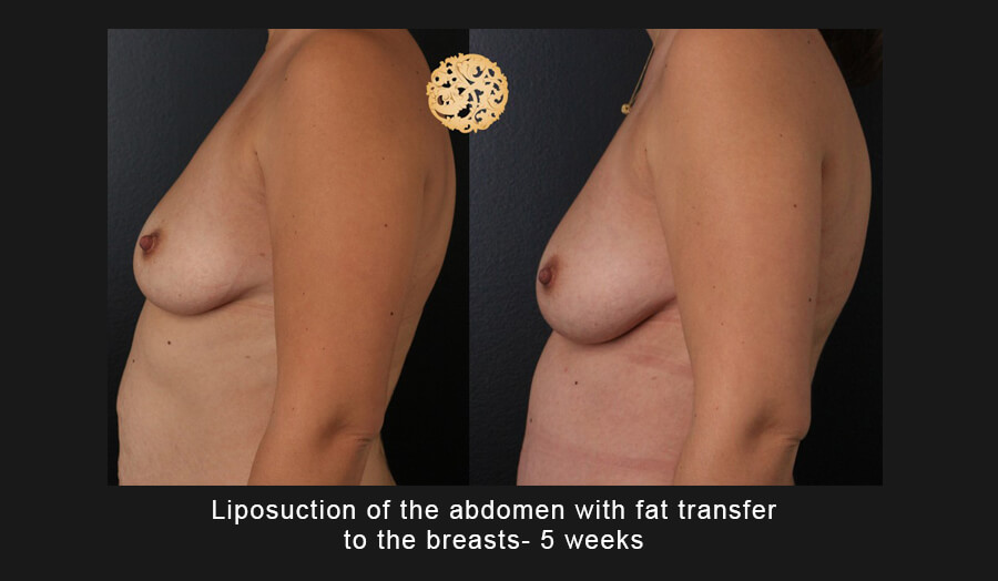 Liposuction Before and After Photo Gallery