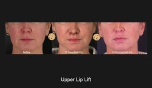 Upper Lip Lift - Shortening The Upper Lip