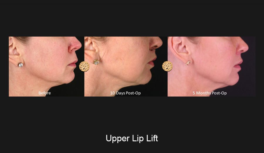 Upper Lip Lift Gallery